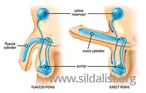 what is sildalist